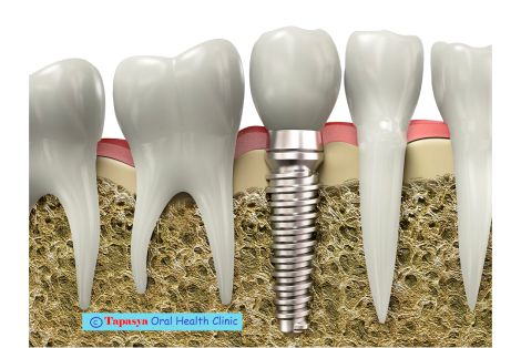 Dental Implants In Ujjain